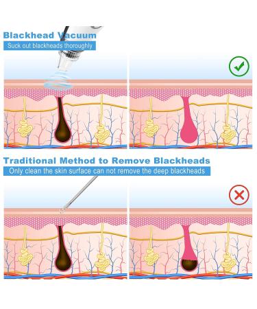 EUASOO USB Rechargeable Blackhead Remover Kit for Women & Men - Electric Pore Vacuum Tool with 10 Filters & 5 Rubber Rings - Buy Online on GoSupps.com