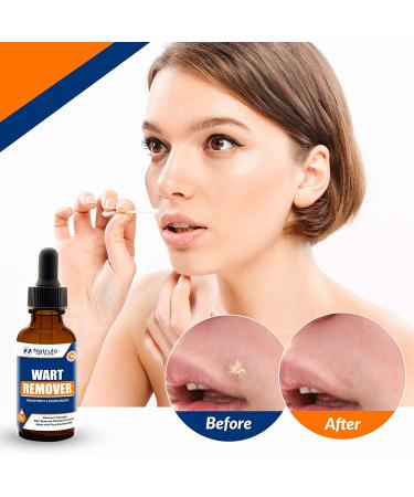 Natural Wart Remover Treatment Liquid - Fast & Safe for Kids - Maximum Strength with Essential Oils - No Pain or Scarring - Easy to Use on Face, Neck, Body, Hands & Feet - Buy Online on GoSupps.com