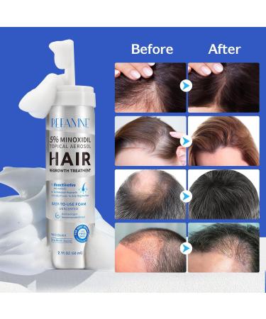 5% Minoxidil Hair Growth Foam for Men & Women - Boost Beard & Scalp Hair Thickness - 2.11 oz - Buy Online on GoSupps.com