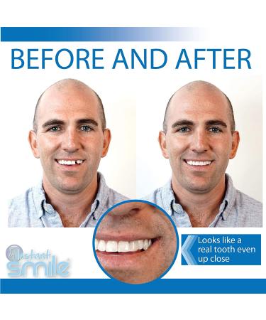 Instant Smile Temporary Tooth Kit - Pro-Series: Transform Your Smile Instantly - Buy Online on GoSupps.com