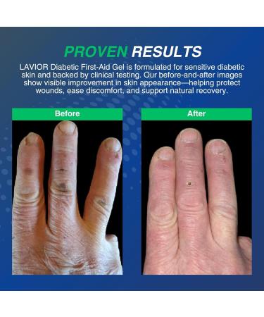 Lavior Diabetic First-Aid Gel 1oz Speeds Healing for Cuts, Scrapes, Burns & Minor Injuries, Physician Recommended, Clinically Proven, Hypoallergenic, Infection Prevention & Pain Relief 1 Ounce (Pack of 1) - Buy Online on GoSupps.com