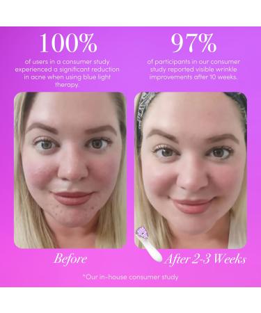 reVive Light Therapy Lux Collection - Clinical Acne & Anti-Aging Device for Flawless Skin - International Shipping Available - Buy Online on GoSupps.com