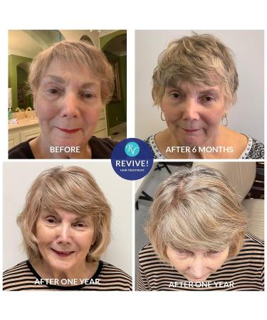 RemeVerse Revive Hair Treatment Serum | Redensyl Serum for Thinning Hair | Procapil, Peptides, DHT Blockers, Vitamins | Promotes Hair Growth | 4 Fl Oz - Buy Online on GoSupps.com