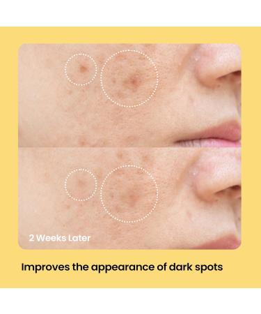 AVARELLE Dark Spot Patches - Acne Treatment (9 CT) | Face & Body Pimple Patches with Vitamin C Niacinamide Tranexamic Acid & Kojic Acid for Post-Blemish Care - Buy Online on GoSupps.com