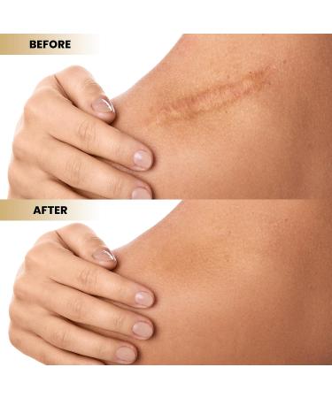 Abera Red Turmeric Scar Removal Cream - Overnight Plumping Treatment - 2 Boxes - Buy Online on GoSupps.com