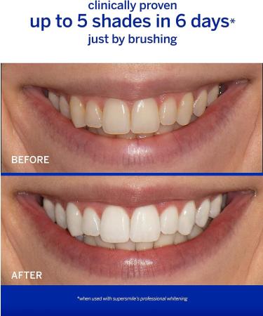 Professional Whitening System - 4-Piece Kit for Bright Radiant Smiles | International Shipping Available - Buy Online on GoSupps.com