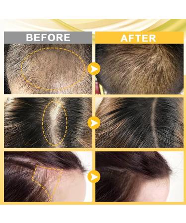 Dermaroller Set Microneedling with Hair Growth Serum Anti Hair Loss Hair Growth Agent Professional Titanium Needles Skin Roller for Stimulating New Hair Growth (0.25mm kit) - Buy Online on GoSupps.com