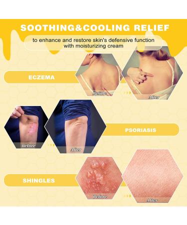 Manuka Honey Eczema Cream with Colloidal Oatmeal - Soothing Relief for Itchy Dry Skin - Plant-Based Formula for Eczema, Psoriasis, and Shingles - Buy Online on GoSupps.com