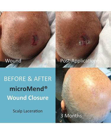 microMend Emergency Wound Closures - Surgical Quality Laceration Repair Without Stitches - Combo Pack (Small & Medium) for Camping Gear - Buy Online on GoSupps.com