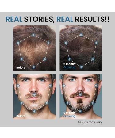 AVITAPURE 5% Minoxidil Hair Growth Serum for Men Extra Strength Treatment to Combat Hair Loss and Thinning Pack Of 2 - Buy Online on GoSupps.com
