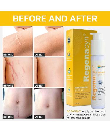 Regenacyn Scar Gel - Advanced Acne & Stretch Mark Treatment with Hypochlorous Acid - Works on Old & New Scars - 1oz - Buy Online on GoSupps.com