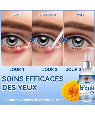 S rum pour Yeux contre les Orgelets S rum Naturel pour Yeux pour Orgelets Bl pharite Nettoyage Quotidien Soulage la S cheresse et Restaure une Peau plus Saine - Buy Online on GoSupps.com