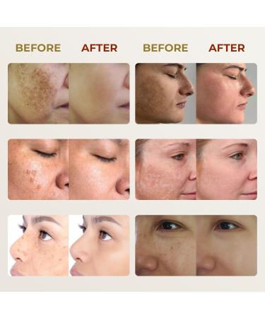 ABERA Melasma Cream (Premium Version) - Cream for Skin Care and Hydration Promoting Radiant and Healthy-Looking Skin Suitable for Sensitive Skin (1 Box + Gift) - Buy Online on GoSupps.com