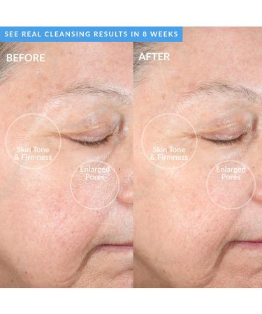 PMD Clean Acne - Smart Facial Cleansing Device with Silicone Brush & Blue Light Treatment for Acne - Waterproof & SonicGlow Technology - Buy Online on GoSupps.com