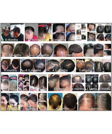 New Cavilla Hair Tonic: Oriental Secrets for Hair Growth in USA | Thicker Fuller Hair, Re-Growth, Anti-Thinning | Organic Natural Herbs - Buy Online on GoSupps.com