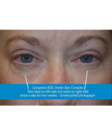 Under Eye Complex with Miracle Haloxyl - Reduce Dark Circles & Puffy Eyes Naturally | Shop Internationally - Buy Online on GoSupps.com