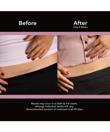 ScarAway Silicone Scar Sheets for C-Sections - Hypertrophic & Keloid Scar Treatment - 4 Reusable Sheets (1.5 x 7) - Buy Online on GoSupps.com