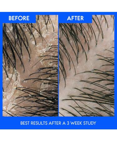 Head & Shoulders Citrus Breeze Anti-Dandruff Shampoo 370ML - Buy Online on GoSupps.com