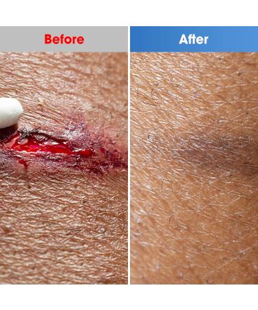 Buy Ourned Hydrocolloid Dressings 5cm x 10cm - Extra Thin 0.3mm Waterproof Wound Care for Ulcers Burns & Blisters - 10 Pieces - Buy Online on GoSupps.com