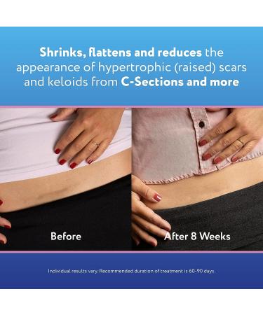 ScarAway Silicone Scar Sheets for C-Section, 4 Reusable 1.5 x 7 Sheets for Hypertrophic & Keloid Scars - Buy Online on GoSupps.com