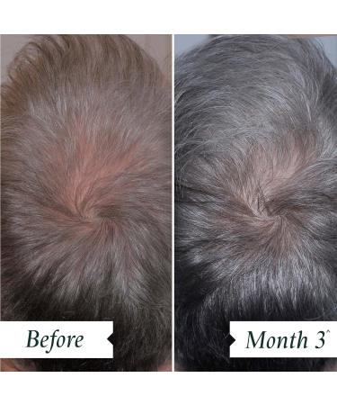 PHILIP KINGSLEY Scalp Drops 2.87 oz - Hair Density Serum for Thinning Hair, Hair Loss, and Scalp Care - Buy Online on GoSupps.com