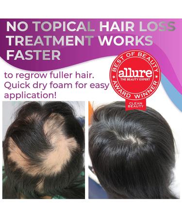 Remixidil Women's 5% Minoxidil Foam - Hair Regrowth Treatment 3-Month Supply - Buy Online on GoSupps.com