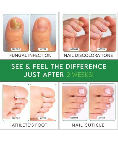 Extra Strength Toenail Fungus Treatment - Antifungal Nail Solution for Athletes Foot & Fungal Nail Infections - Buy Online on GoSupps.com