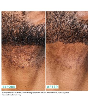 Urban Skin Rx Men Razor Bump & Dark Spot Treatment | Lactic & Glycolic Acid Formula for Blemishes | Niacinamide & Tea Tree Oil | 1.7 Fl Oz - Buy Online on GoSupps.com