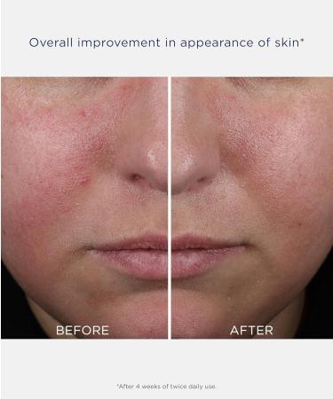 NEOSTRATA CLARIFY Mandelic Clarifying Hydra Gel Matte Face Moisturizer for Oily and Acne Prone Skin Exfoliates and Refines Pores with Salicylic Acid Oil Free Hydration Non-Comedogenic 1.7 oz - Buy Online on GoSupps.com