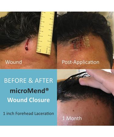 microMend Emergency Wound Closures Kit - Surgical Quality Laceration Repair Without Stitches - Includes 2 Medium Devices, Gauze, and Antiseptic Wipe - Buy Online on GoSupps.com