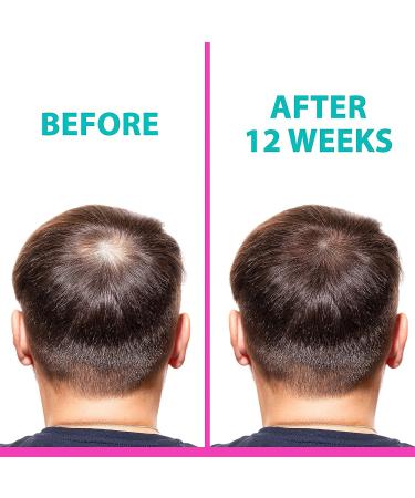 T2 Hair Loss Leave In Vials for Weak & Fine Hair (12 Vials) - Natural Hair Growth Oil Scalp Treatment with Peppermint, Rosemary & Castor Oil - Buy Online on GoSupps.com