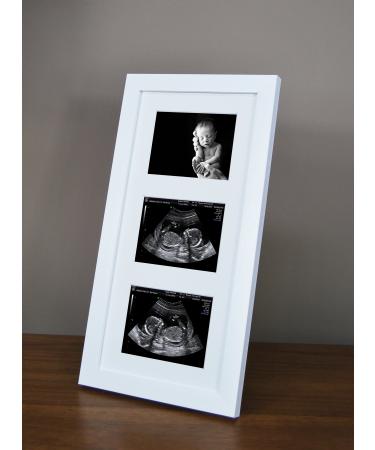 SignatureFrames Baby Scan Photo Frame. Triple ultrasound scan frame in gloss white.