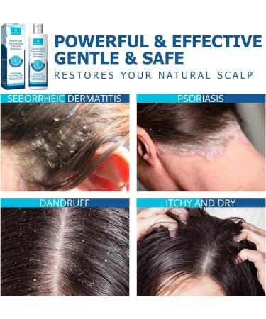 Roycederm Seborrheic Dermatitis Shampoo: Psoriasis, Dandruff, Folliculitis Treatment - Buy Online on GoSupps.com