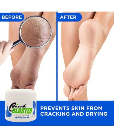 Buy Dry Skin Lanolin Cream - Heal Cracked Heels Elbows & Soft Hands | Crack Blaster Revive - Fast International Shipping - Buy Online on GoSupps.com