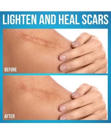 JJ CARE Silicone Scar Sheets [Pack of 15] - Medical Silicone Scar Removal Strips for Keloid, Acne, Burns & Surgery Scars - 1.5x3 Reusable Treatment Sheets - Buy Online on GoSupps.com