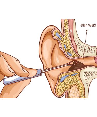 REMOS Stainless Steel Ear Wax Remover - Easy Earwax Removal Tool 7cm-23.4 Violet - Buy Online on GoSupps.com