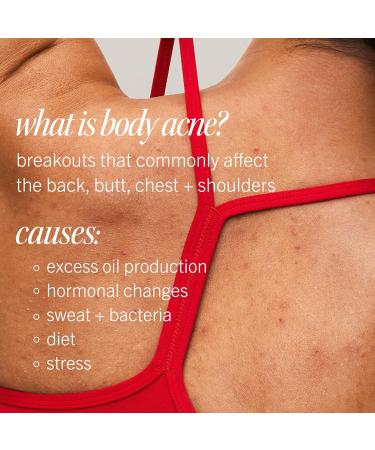 First Aid Beauty Body Acne Spray - Maximum Strength Body Acne Treatment With 360-Degree Sprayer - 2% Salicylic Acid Formula, (3.0 oz) Unscented 3 Fl Oz (Pack of 1) - Buy Online on GoSupps.com