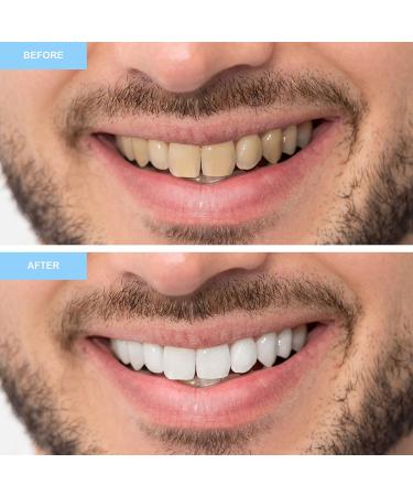 Meawhite Tooth Light Set - Professional Teeth Whitening Kit for Bright White Smile | Peroxide-Free Home Bleaching - Buy Online on GoSupps.com