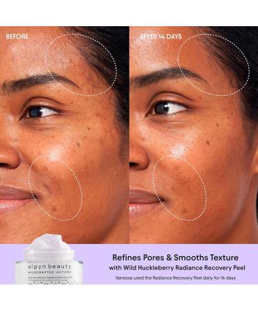 Alpyn Wild Huckleberry Recovery Peel - Exfoliate Moisturize & Soothe Skin | Reduce Redness | 1.7 oz / 50 ml - International Shipping Available - Buy Online on GoSupps.com