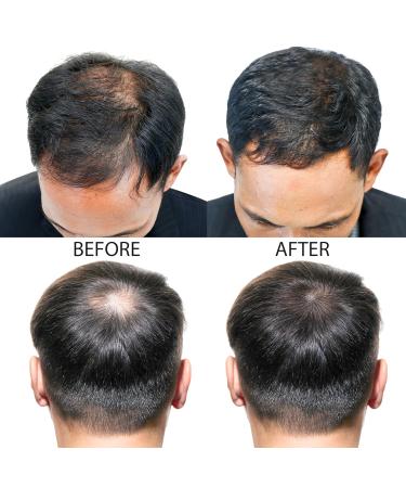 Advanced 5% Minoxidil Hair Regrowth Treatment for Men - 6 Month Supply for Thinning Hair & Hair Loss - Topical Solution for Fuller Thicker Hair - Buy Online on GoSupps.com