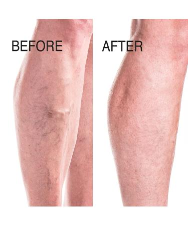Advanced Clinicals Vein Care Cream - Firming Lotion for Varicose & Spider Veins - 3-Pack, 8 Fl Oz Each - Buy Online on GoSupps.com