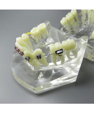 Shop Dental Malocclusion Orthodontic Treatment Model - Metal Brackets & Colorful Ties | M3005 - International Shipping Available - Buy Online on GoSupps.com