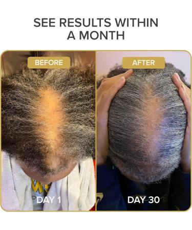 Shedavi Iconic Natural Hair Vitamins for Fast Hair Growth - Pure Hair Supplements Formulated with Vitamins to Promote Thicker Stronger Hair - Vegan Hair Care for Hair Loss - Non-GMO (60 Capsules) - Buy Online on GoSupps.com