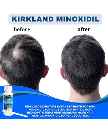 Kirkland Minoxidil 5% Extra Strength 6 Month Supply for Men - Hair Regrowth Treatment - 2 Fl Oz (Pack of 6) + Bonus Key Chain - Buy Online on GoSupps.com