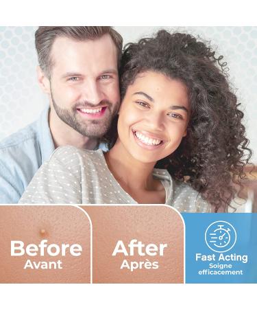 BASIC CONCEPTS Acne Patches (120 Pack) - Tea Tree Oil and Hydrocolloid Pimple Stickers for Face - 3 Sizes Blemish Dots for Clear Skin - Buy Online on GoSupps.com
