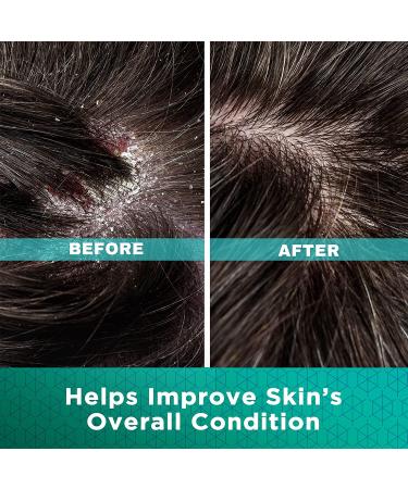 Dermoscribe Seborrheic Dermatitis & Eczema Cream - Fast-Acting Itchy Skin Relief | 2 oz - Buy Online on GoSupps.com