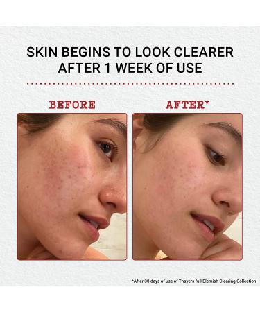 Thayers Blemish Clearing Salicylic Acid & Witch Hazel Acne Pads - 60 Count (Alcohol-Free) - Buy Online on GoSupps.com