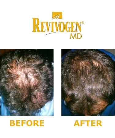 REVIVOGEN MD Scalp Therapy | Natural Hair Loss Solution for Fine & Thinning Hair - International Shipping - Buy Online on GoSupps.com