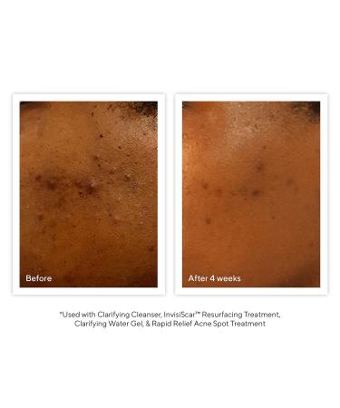 Shop Murad Acne Control Clarifying Cleanser - 6.75 oz Online - Best Price & International Shipping - Buy Online on GoSupps.com