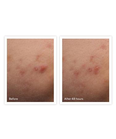 Shop Murad Rapid Relief Acne Spot Treatment - 0.5 oz/ 15 mL Online - Best Price & International Shipping - Buy Online on GoSupps.com